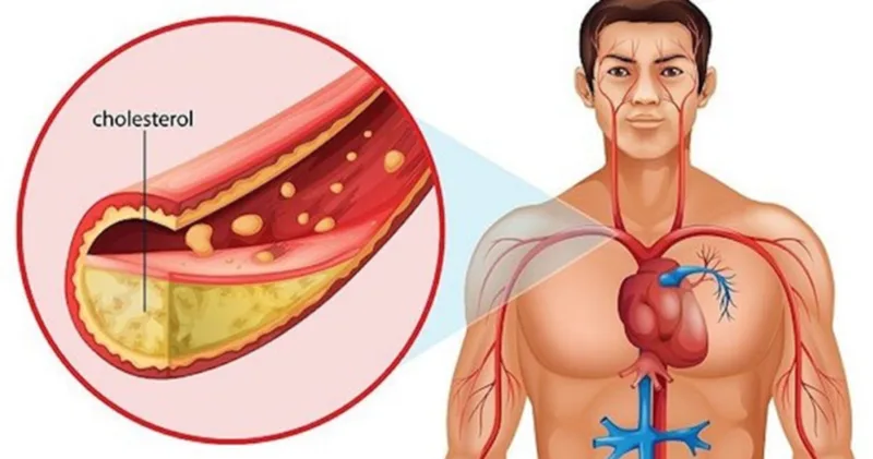 Khi cholesterol tích tụ trong thành mạch, lòng mạch có thể hẹp dần và cản trở dòng máu.